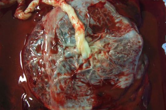 La placenta humana