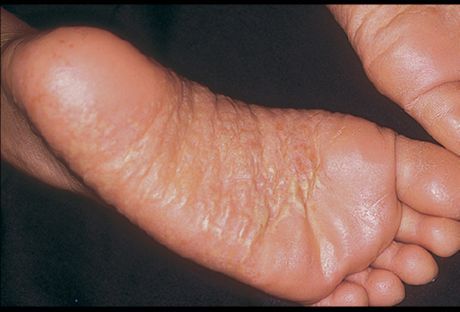 Dermatitis de piernas y sus causas