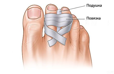 ¿Cuáles son las perspectivas de restaurar dedos de los pies rotos?