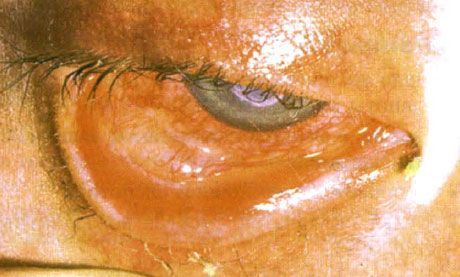 Síndrome de Stevens-Johnson.  Conjuntivitis descamativa a dos lados con áreas de necrosis.  Queratitis fuerte, que causó la aparición de cicatrices en la córnea.  La situación se complicó con la adición del síndrome de ojos "secos"