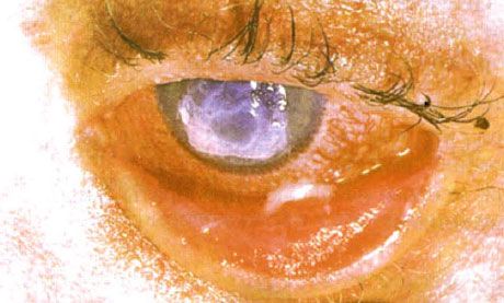Síndrome de Stevens-Johnson.  Conjuntivitis descamativa a dos lados con áreas de necrosis.  Queratitis fuerte, que causó la aparición de cicatrices en la córnea.  La situación se complicó con la adición del síndrome de ojos "secos"