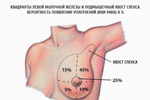 Los cuadrantes del seno izquierdo y la spence axilar del spence.  La probabilidad de sellos (o cáncer) en%