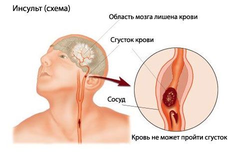 Una prueba fácil predice un accidente cerebrovascular fatal