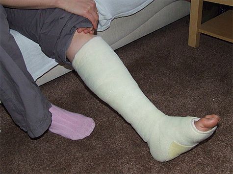 Medidas en casa con fractura de piernas
