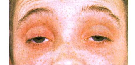 Oftalmoplejía externa  Ptosis bilateral.  El paciente abre los ojos alzando las cejas