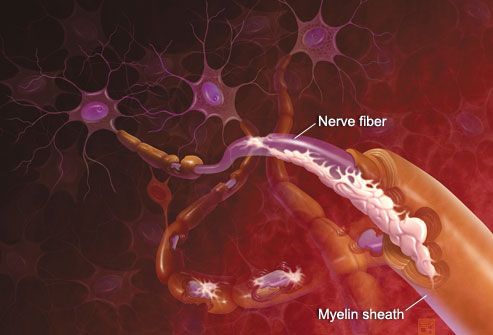 Cómo funciona la esclerosis múltiple