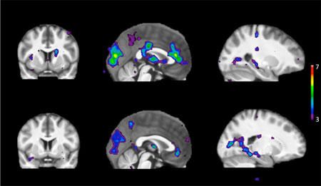 El escaneo muestra áreas de actividad cerebral en respuesta a estímulos en personas con un metabolismo rápido de nicotina (fila superior) y un metabolismo lento de nicotina (fila inferior)