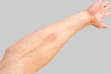 Linfangitis Reticular Linfangitis: causas, síntomas, diagnóstico y tratamiento. | Health ...