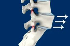 Inestabilidad de la columna lumbar: causas, diagnóstico y tratamiento ...