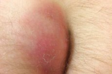 Absceso pilonidal: síntomas, diagnóstico, tratamiento y pronóstico ...
