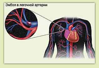 Embolia pulmonar y dolores de pecho a la izquierda