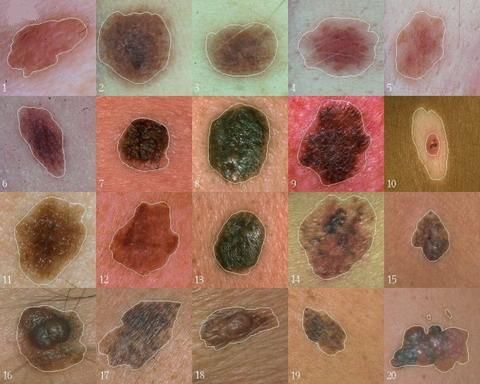 Los científicos han encontrado un gen que juega un papel central en el desarrollo del melanoma