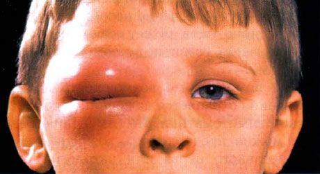 Celulitis extraorbital en niños